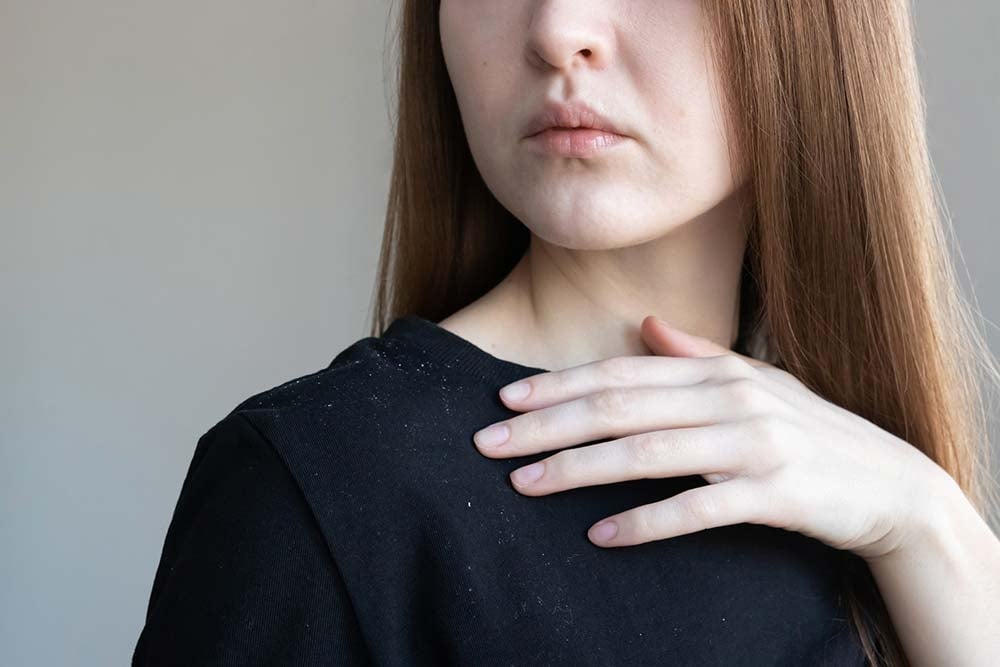 Перхоть представляет собой микс клеток кожи и себума