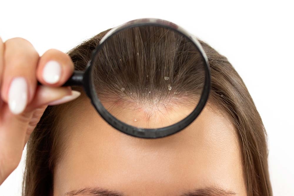 Ищем причину появления перхоти