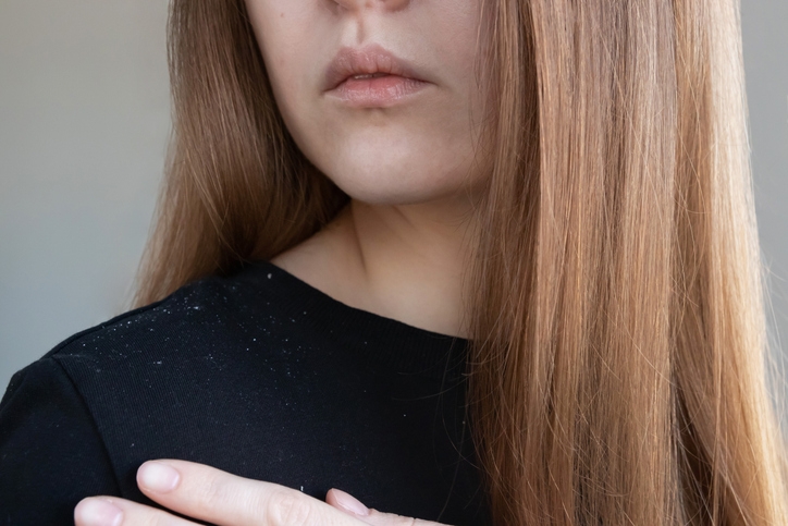 Перхоть на разных типах волос